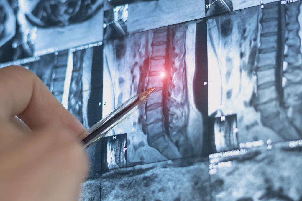 Röntgenbild der Wirbelsäule mit Hinweis auf osteoporotische Fraktur